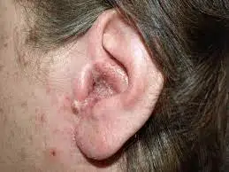 Ear Canal Infections