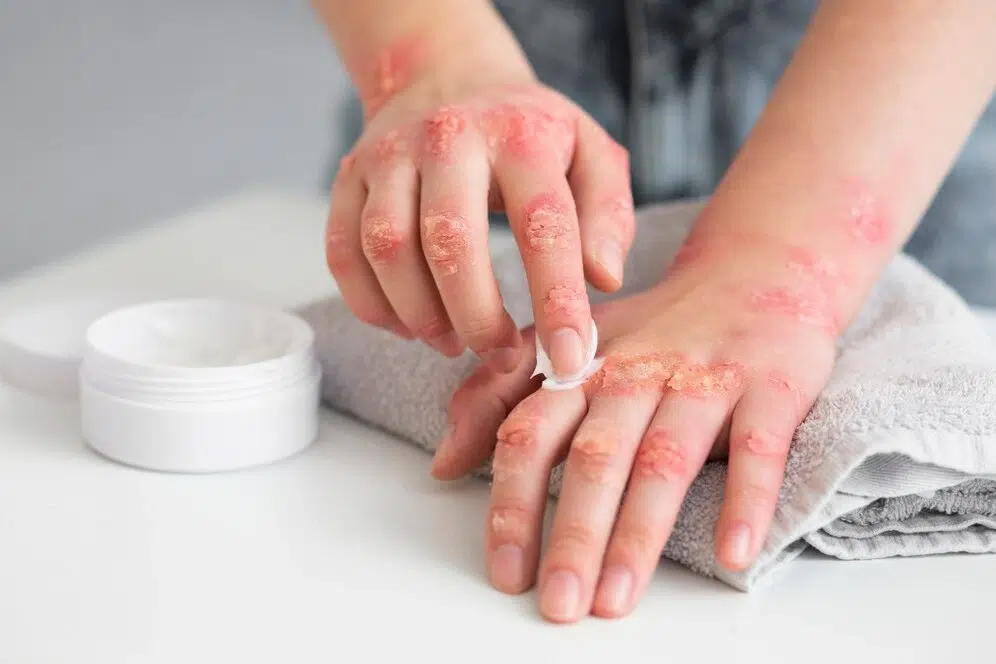Eczema