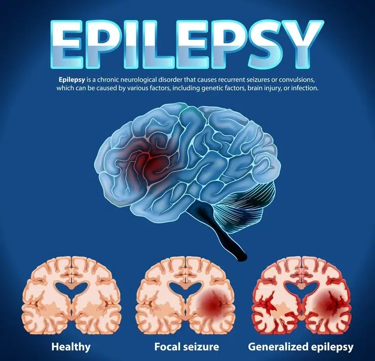Epilepsy