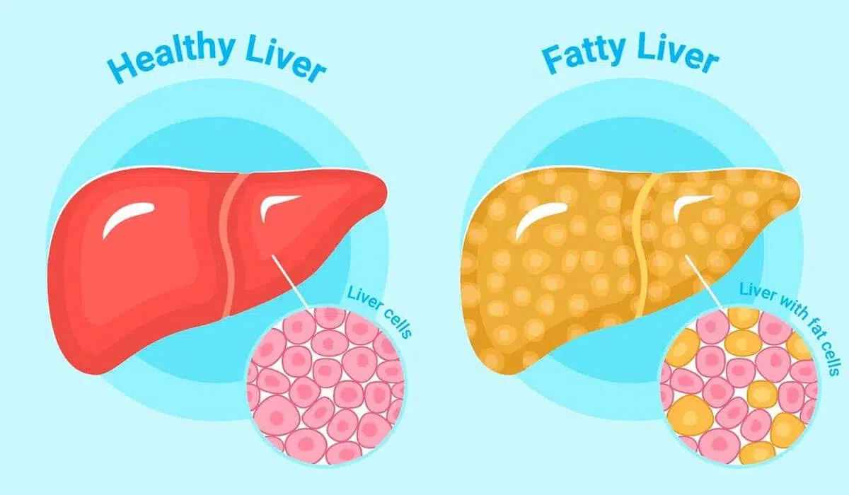 Fatty Liver