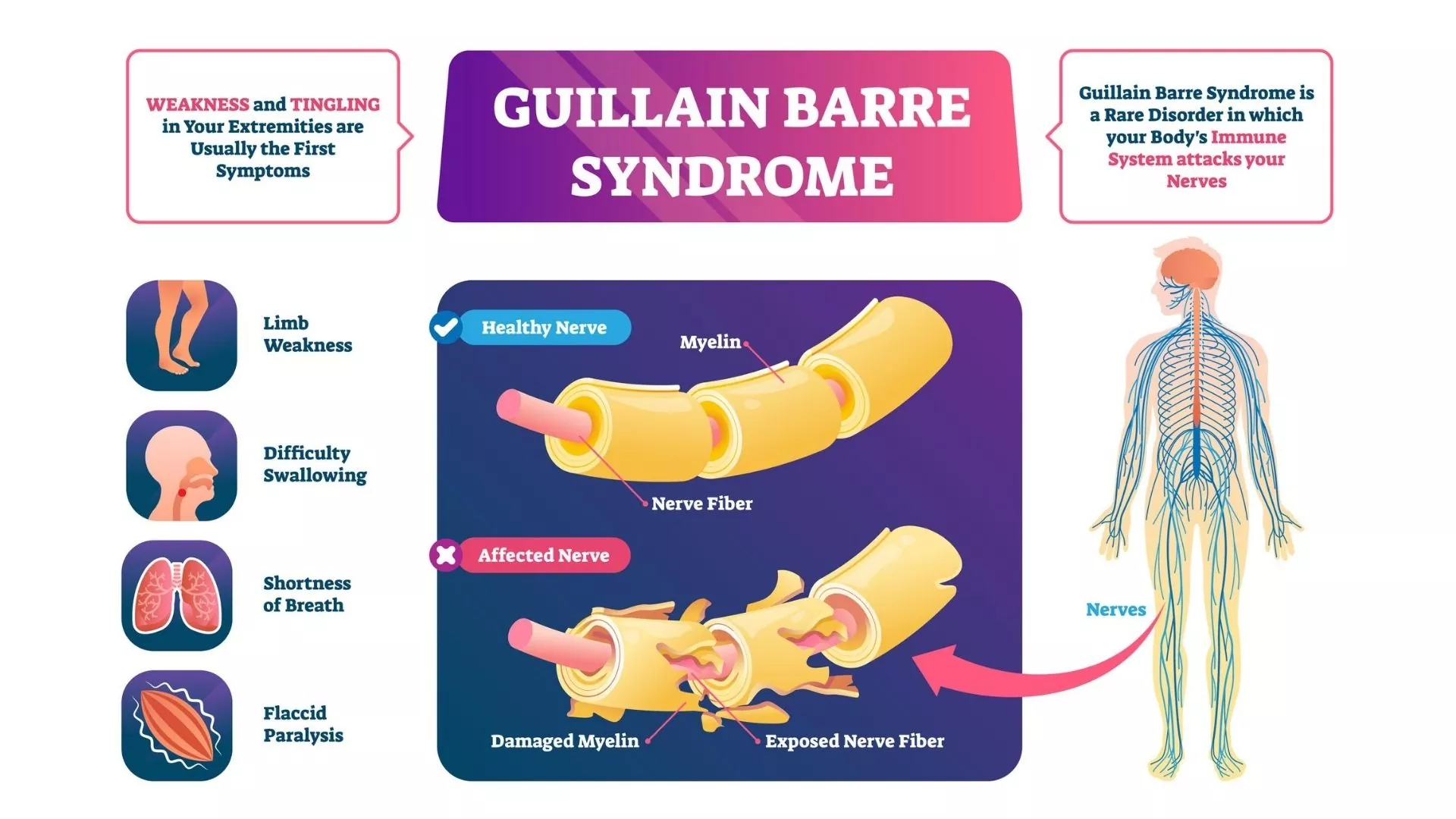 Guillain Barre Syndrome