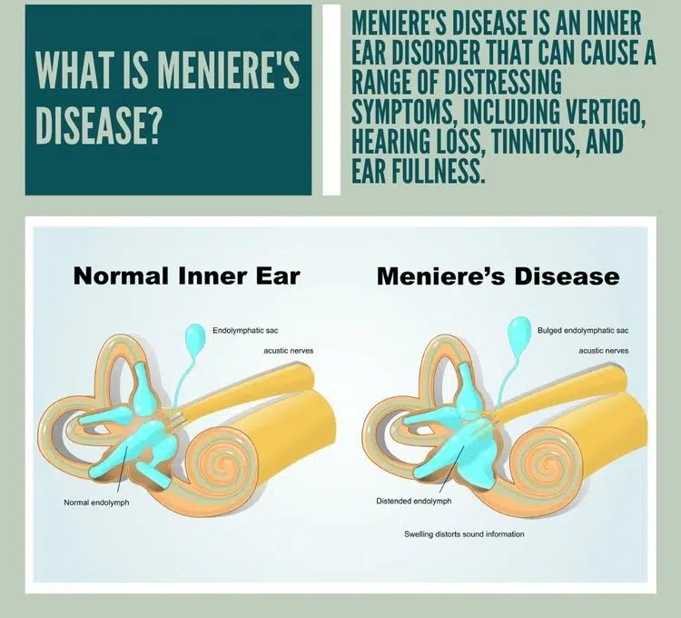 Meniere’s Disease