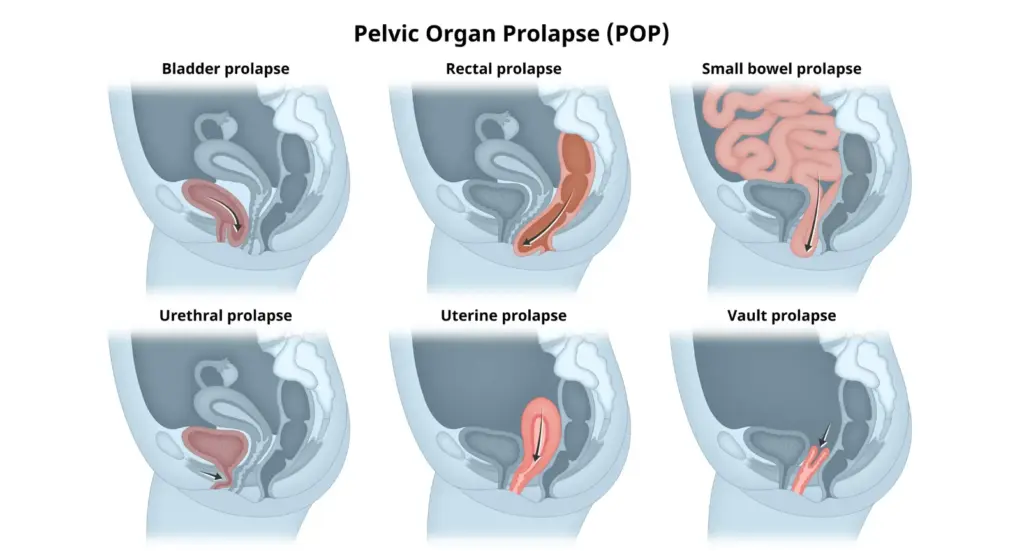 Pelvic Organ Prolapse