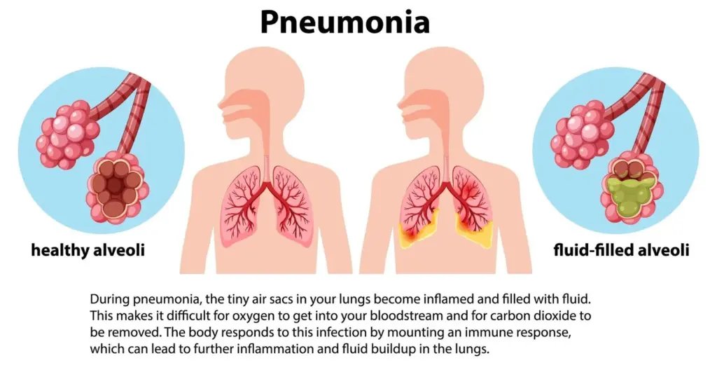 Pneumonia